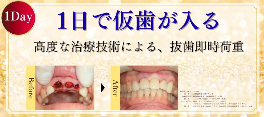 1日で仮歯が入る高度な治療技術による、抜歯即時荷重
